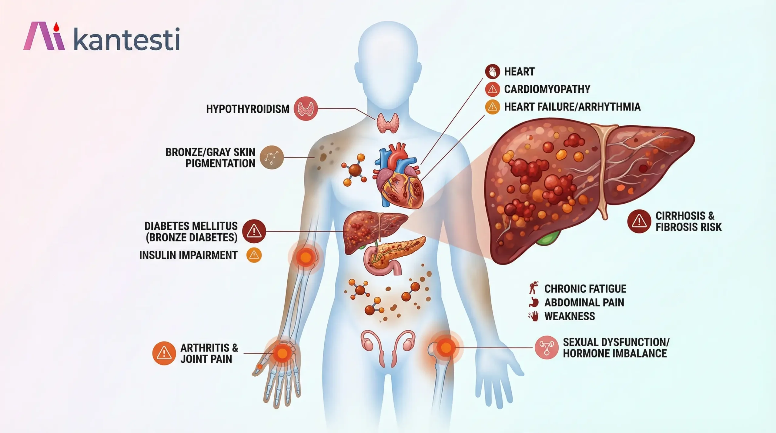 Hemochromatosis and iron overload warning signs including joint pain, fatigue, abdominal pain, bronze skin discoloration, and liver complications