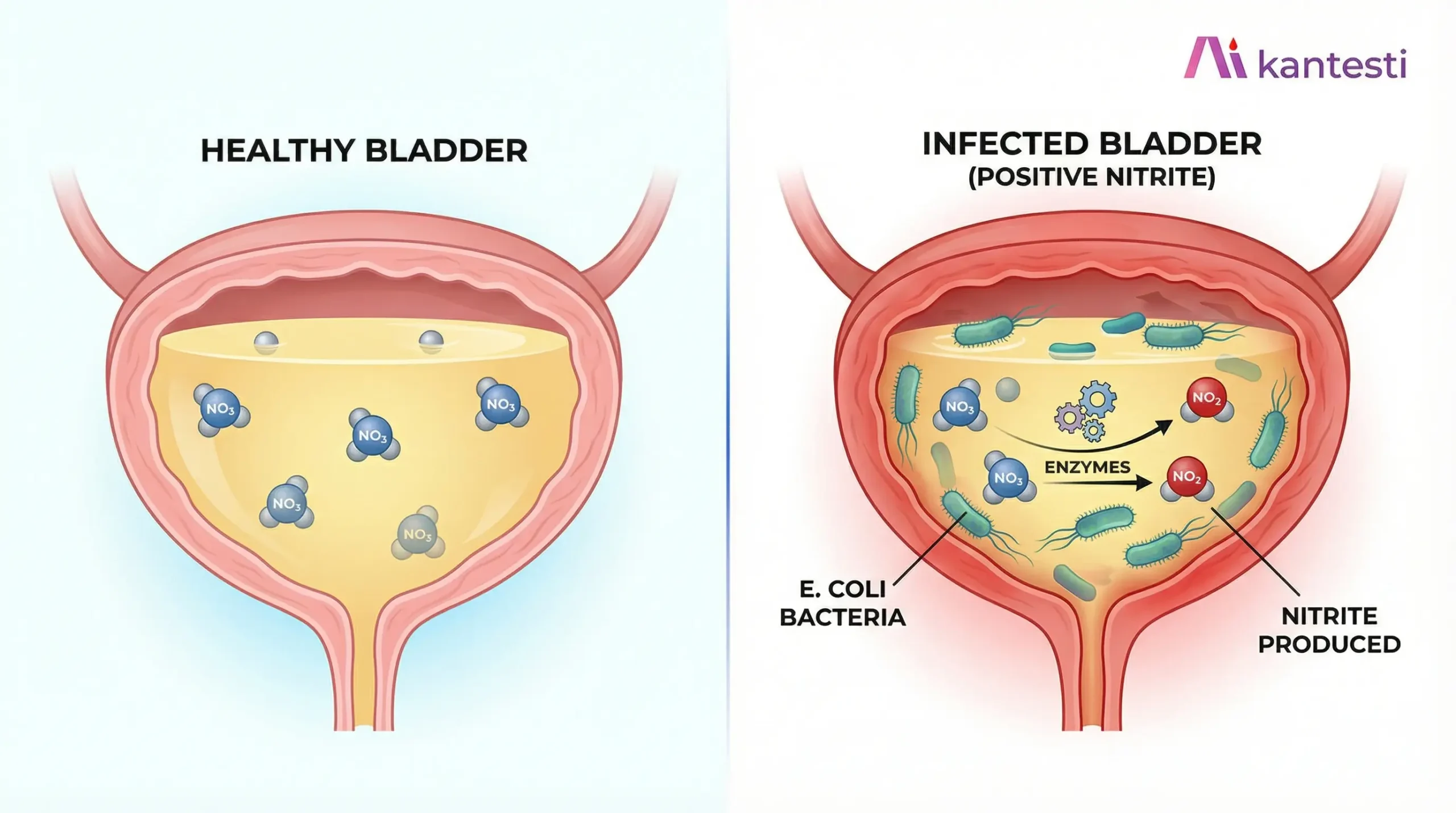 Εικονογράφηση ουρολοίμωξης που δείχνει βακτήρια E. coli που μετατρέπουν τα νιτρικά σε νιτρώδη στην ουροδόχο κύστη, υποδεικνύοντας βακτηριακή λοίμωξη