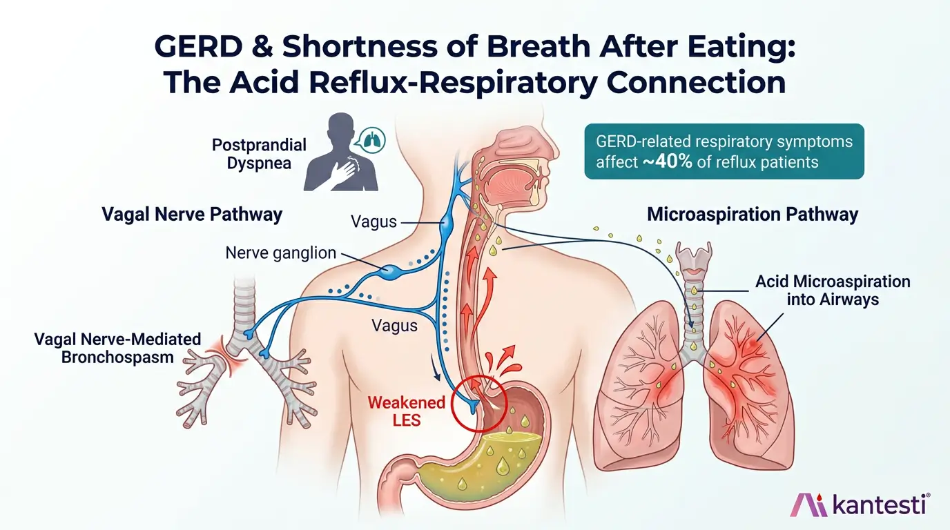 胃食道逆流症（GERD）のメカニズムを視覚的に表したもので、食後に酸の微小吸引と迷走神経を介した気管支痙攣によって息切れを引き起こす胃食道逆流症を示す。
